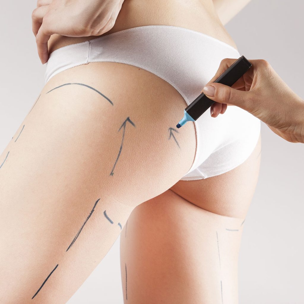 cryolipolyse cellulite lausanne