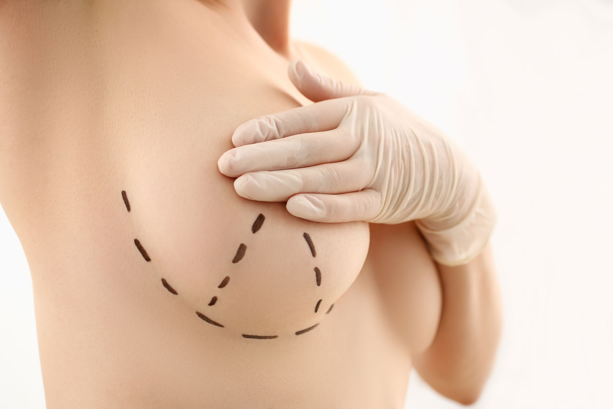 augmentation mammaire suisse lausanne