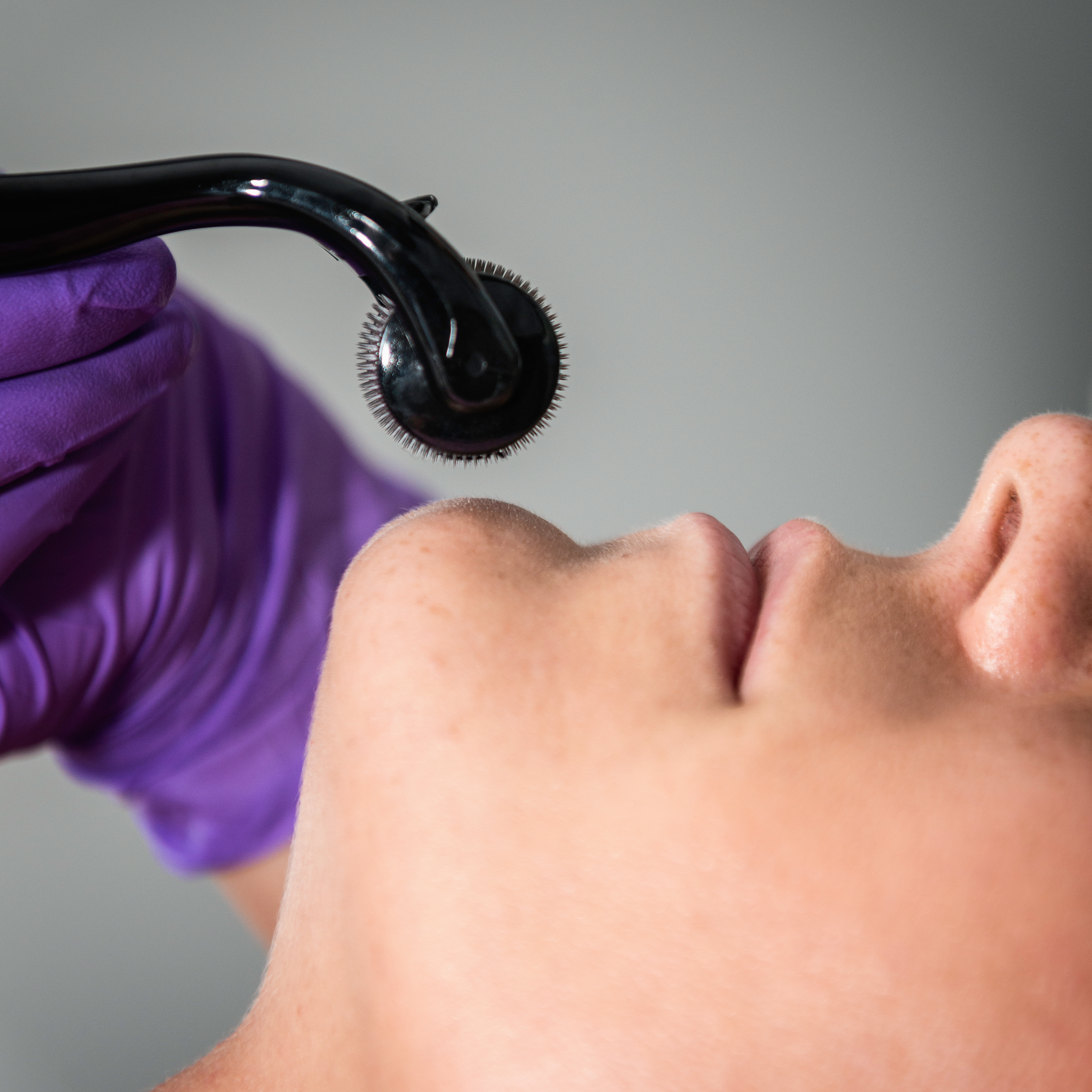 chirurgien microneedling a lausanne dr mercadier